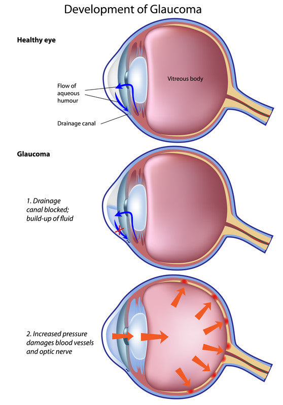 Glaucoma_symptoms_Invercargill
