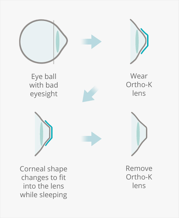 How_does_Ortho_K_work
