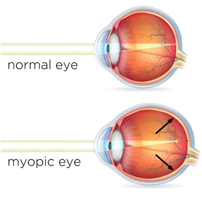 Myopia_Invercargill_Lobb